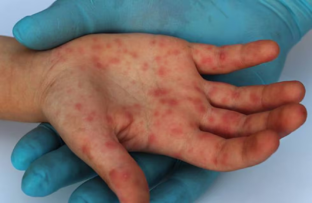 Viruela del mono: detectaron el primer caso en Argentina de la variante más agresiva y contagiosa