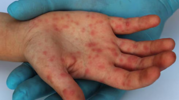 Viruela del mono: reportan 10 nuevos casos en el país