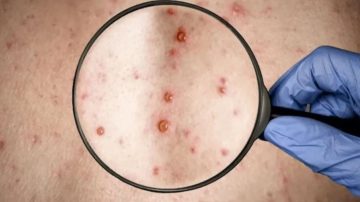 Viruela del mono: en la última semana se registraron 10 nuevos casos