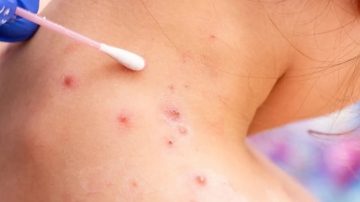 Confirmaron 2 nuevos casos de viruela del mono en Córdoba y crece la preocupación