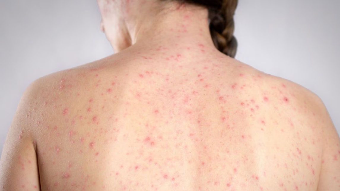 Alerta epidemiológico: Registran cuatro casos de sarampión en CABA