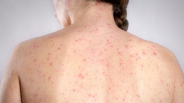 Alerta epidemiológico: Registran cuatro casos de sarampión en CABA