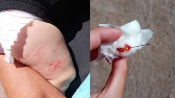 Una mujer denunció que le dejaron una aguja en la pierna a su bebé tras vacunarlo
