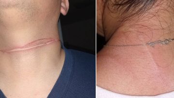 Pescador casi provoca una tragedia: enganchó del cuello con la tanza a dos motociclistas