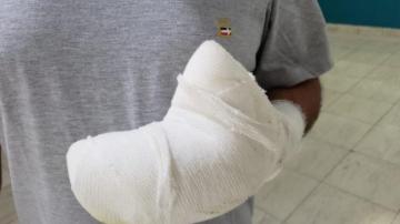 Participaba en la vigilia por el aniversario de Estudiantes, le explotó una bomba en la mano y le amputaron tres dedos