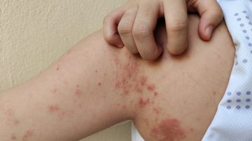 Alarma en Salta por la aparición de casos de lepra