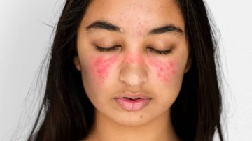 Día Mundial del Lupus: de qué se trata esta enfermedad autoinmune que afecta a 22 mil argentinos