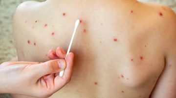 Brote de sarampión: ¿Cómo es la situación en Santiago del Estero?