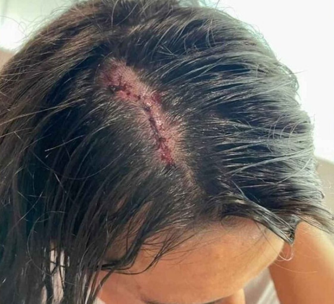 Joven acabó en el hospital tras caerle una botella de vidrio desde un primer piso