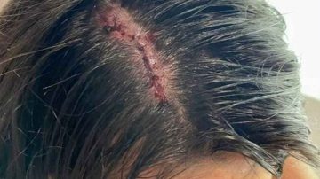 Joven acabó en el hospital tras caerle una botella de vidrio desde un primer piso