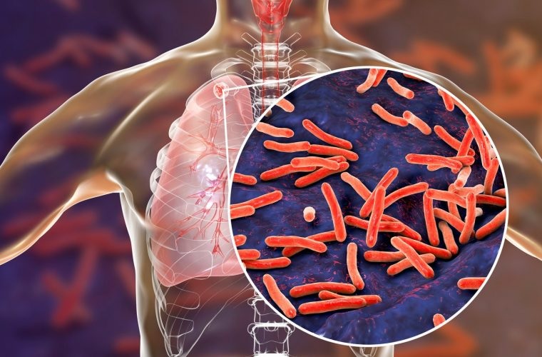 Alarma por el aumento de tuberculosis en Argentina: suben los casos un 38%