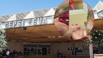 Loreto: bebé sufrió serias quemaduras al caerle una olla con guiso