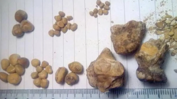 Le sacaron 35 piedras de la vejiga a un hombre que tomaba 3 litros de Coca-Cola por día