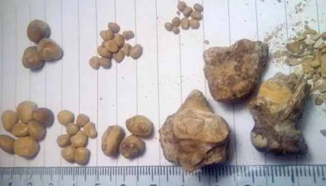 Le sacaron 35 piedras de la vejiga a un hombre que tomaba 3 litros de Coca-Cola por día