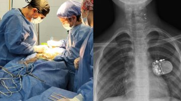 El Cepsi hace historia con una cirugía de estimulación para el tratamiento de la epilepsia