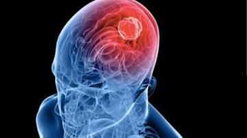 Científicos del CONICET lograron frenar un tipo de cáncer cerebral: la metodología que usaron