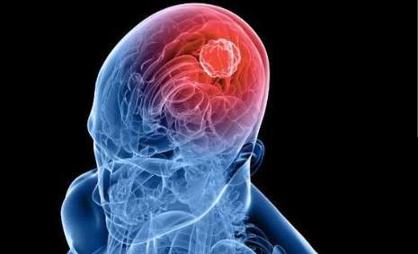 Científicos del CONICET lograron frenar un tipo de cáncer cerebral: la metodología que usaron