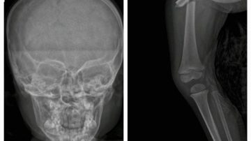 Frías conmovida: Buscan a una mujer que atropelló a un niño de 3 años y huyó tras llevarlo al hospital