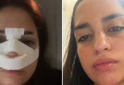 “Me quebró el tabique y nunca obtuve respuesta de la Justicia”: una joven denunció públicamente a su agresor