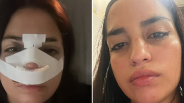 “Me quebró el tabique y nunca obtuve respuesta de la Justicia”: una joven denunció públicamente a su agresor