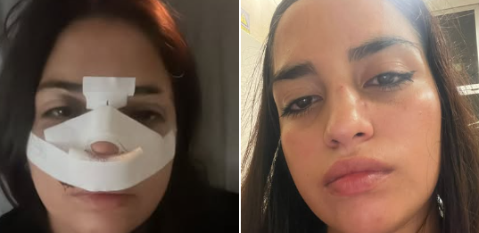 “Me quebró el tabique y nunca obtuve respuesta de la Justicia”: una joven denunció públicamente a su agresor