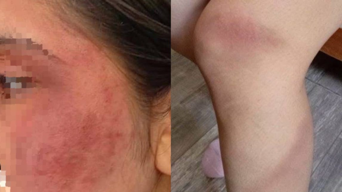 Grave denuncia por violencia de género en Los Mojones: una joven de 19 años fue brutalmente agredida por su pareja