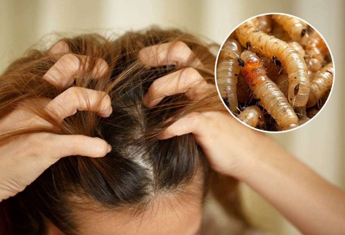 Dan a conocer el estado de salud de la nena de 11 años a la que le encontraron larvas en la cabeza
