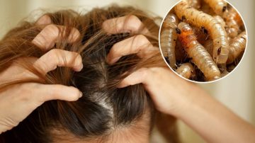 Dan a conocer el estado de salud de la nena de 11 años a la que le encontraron larvas en la cabeza