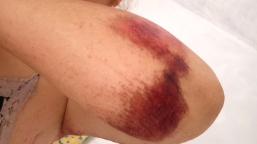 Una joven fue víctima de un motochorro: “Me salvé, lo estoy contando gracias a Dios”