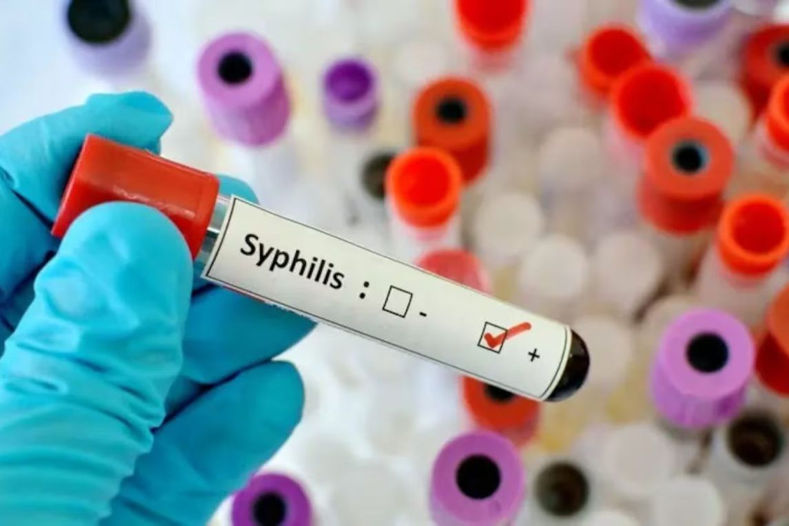 Fuerte salto de sífilis en Argentina: aumentó el 38,5% y se espera un nuevo récord en 2025