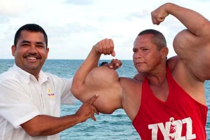Murió el “Popeye brasileño”: el fisicoculturista que se inyectaba aceite para aumentar sus bíceps