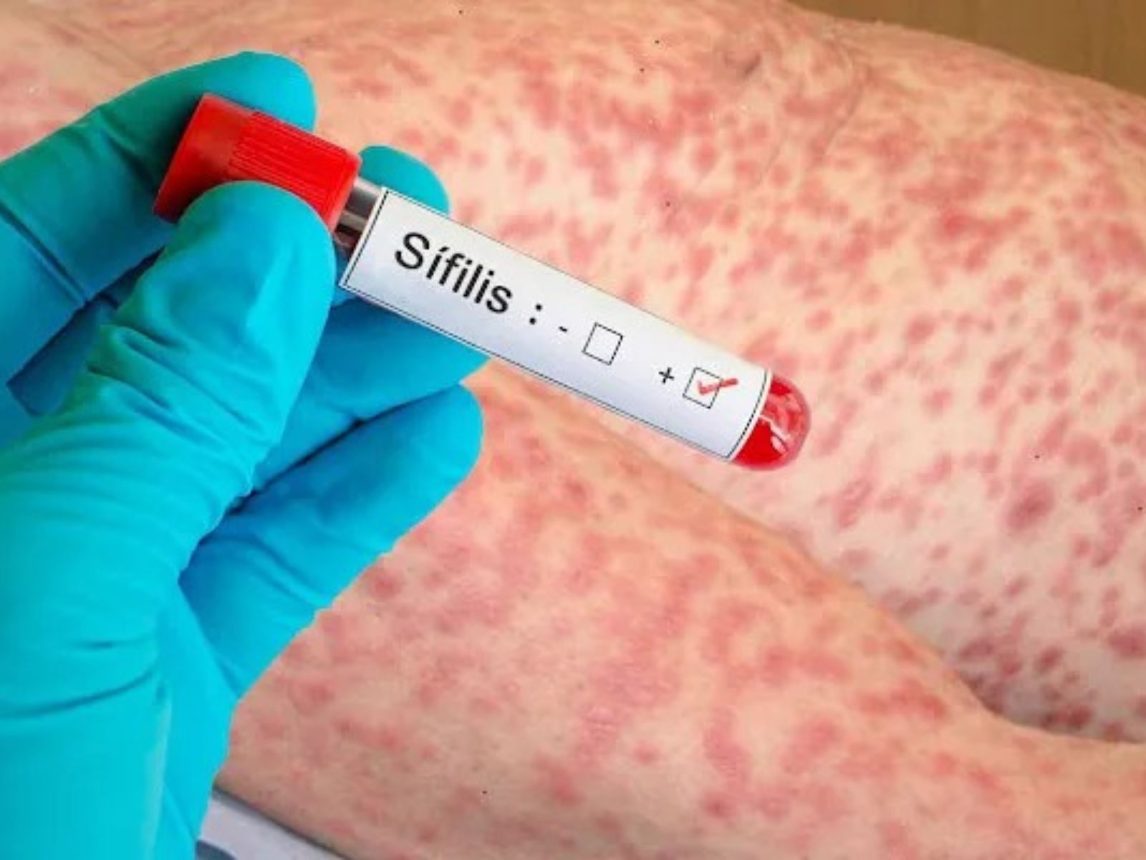 Alerta sanitaria: los casos de sífilis subieron un 71% y alcanzan su cifra más alta en cinco años