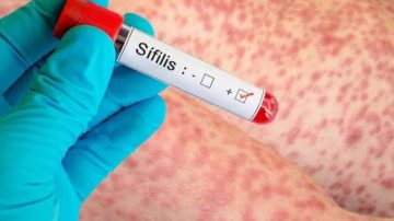 Alerta sanitaria: los casos de sífilis subieron un 71% y alcanzan su cifra más alta en cinco años