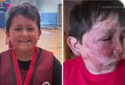 Un reto viral de TikTok provocó graves quemaduras en un niño de 9 años