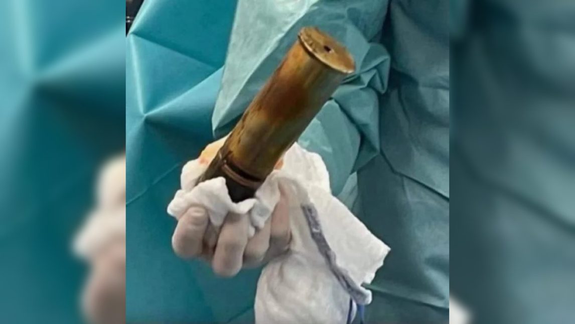 Insólito: paciente de hospital tenía alojado un proyectil de la Primera Guerra Mundial y hubo que evacuar el área