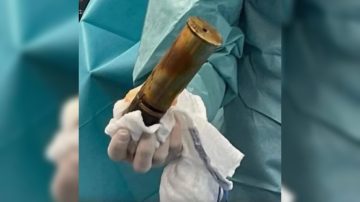 Insólito: paciente de hospital tenía alojado un proyectil de la Primera Guerra Mundial y hubo que evacuar el área