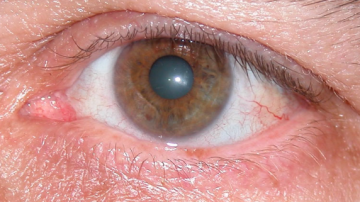 Oportunidad para cuidar la vista: realizarán controles gratuitos para detectar el glaucoma