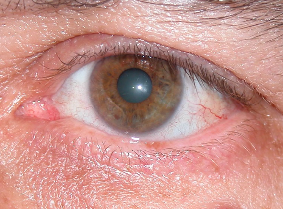 Oportunidad para cuidar la vista: realizarán controles gratuitos para detectar el glaucoma