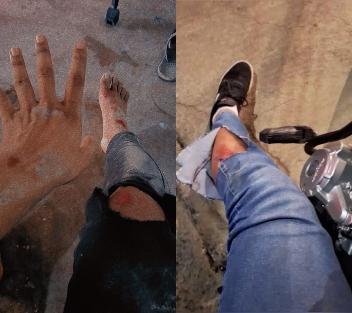 Una joven se accidentó tras ser atacada por perros en Las Termas: “¿De quién son? De nadie”